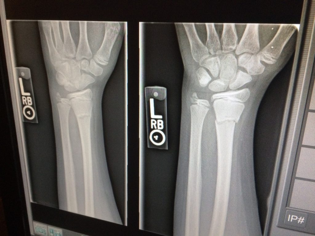 x-ray, medical, broken-1273382.jpg